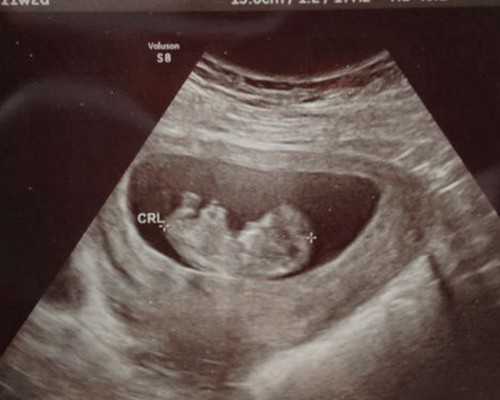 武汉第三代试管婴儿需要多少钱?千万别忽视!